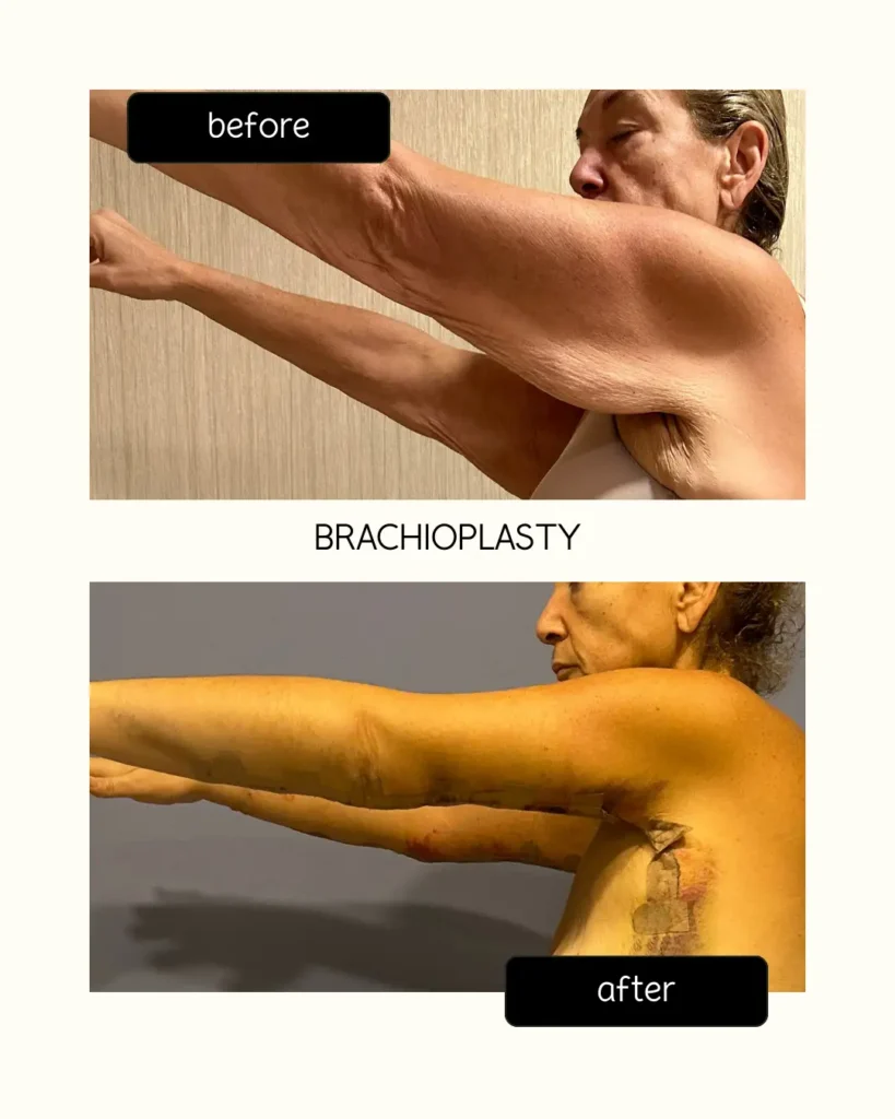 kol-germe-ameliyati-2